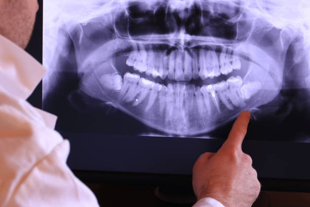 Best Emergency Wisdom Teeth Removal in Earlysville, VA