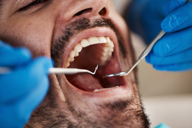Best Emergency Tooth Extraction in Earlysville, VA