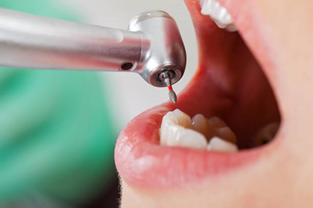Best Emergency Wisdom Teeth Removal in Earlysville, VA